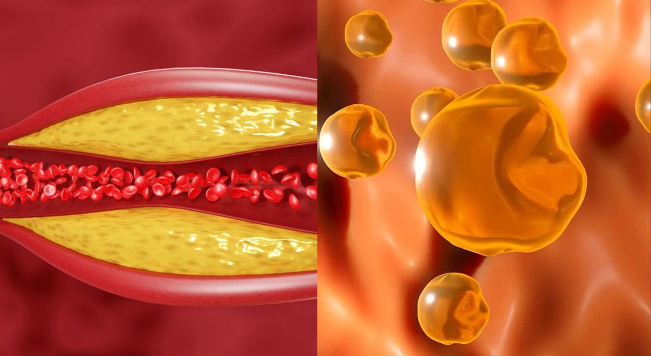 High Cholesterol Symptoms