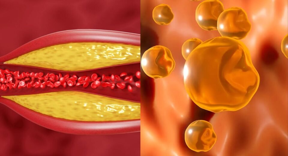 High Cholesterol Symptoms