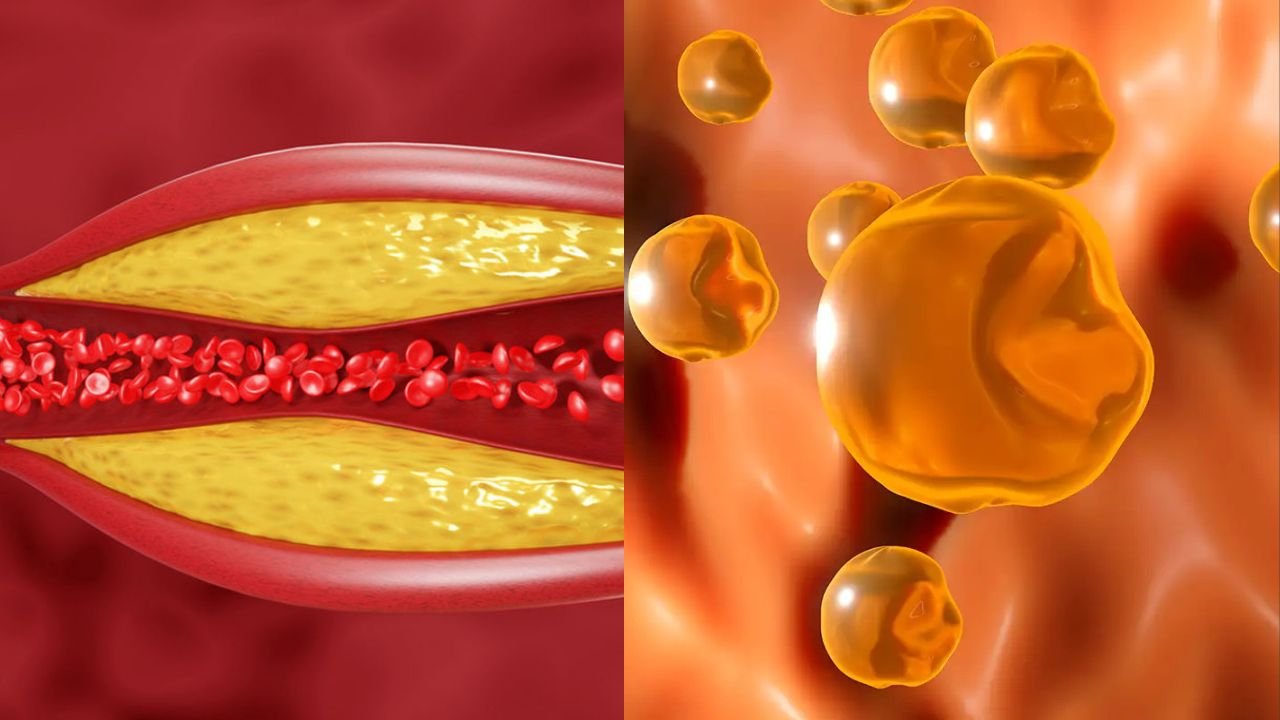 High Cholesterol Symptoms