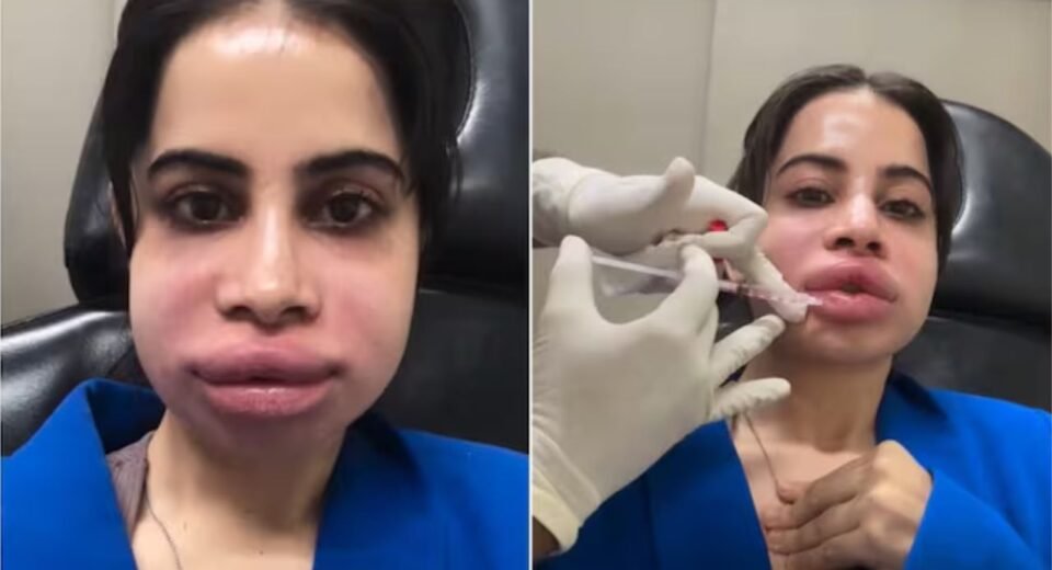 Urfi Javed Lip Filler Removal